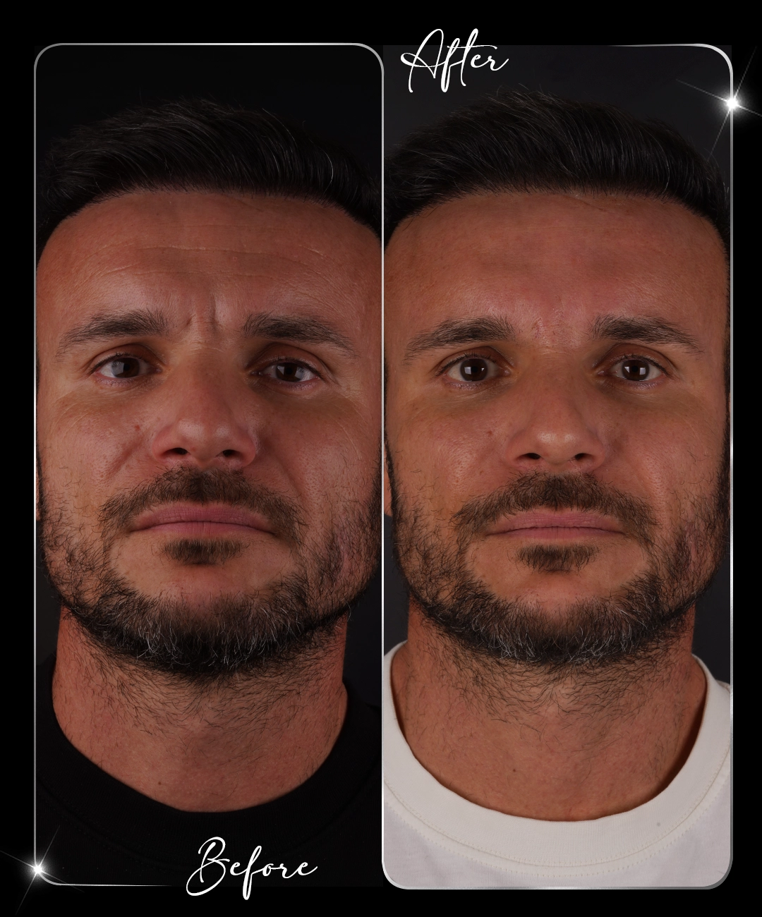 Botox – Înainte și după – 2