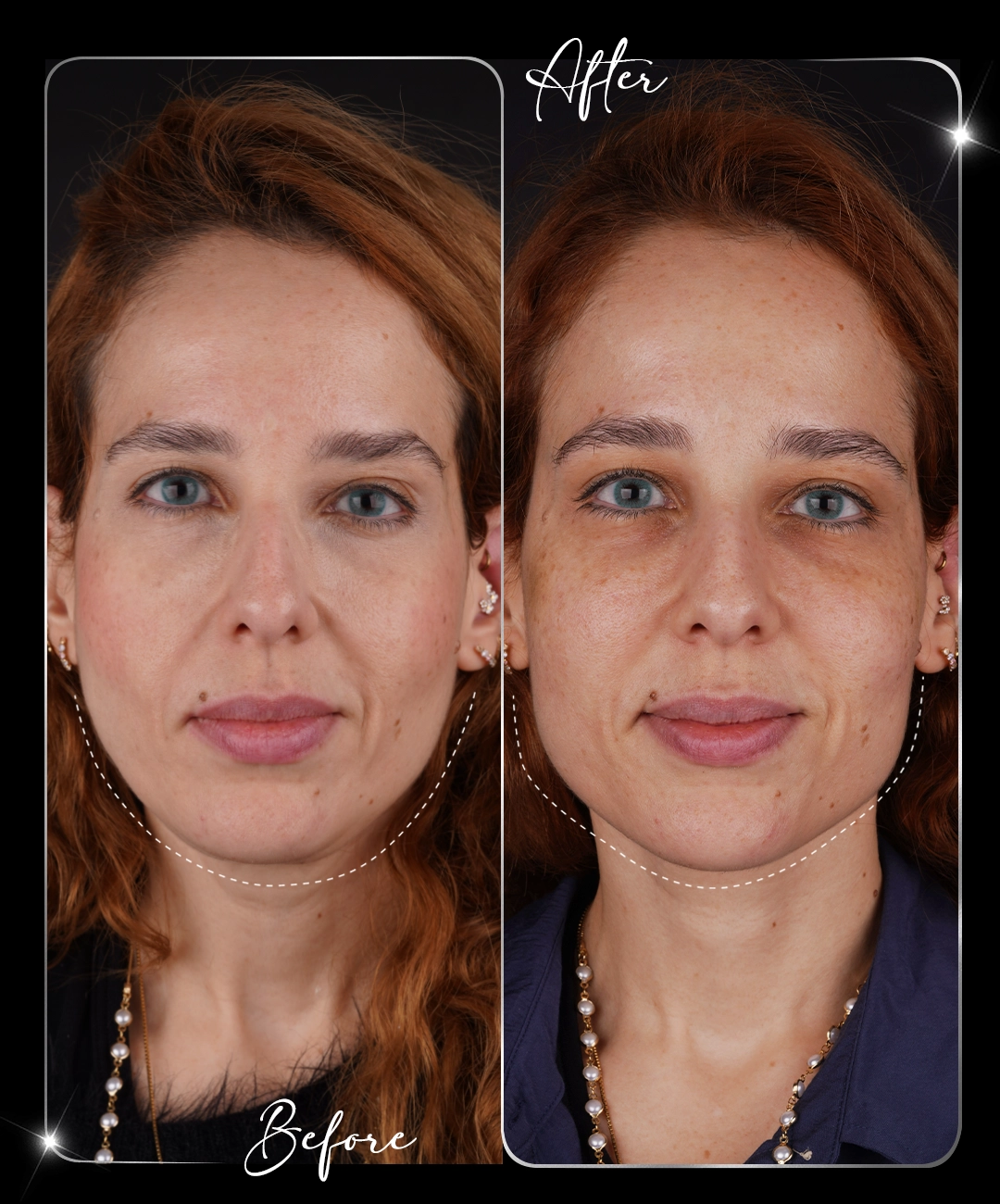 Botox – Înainte și după – 3