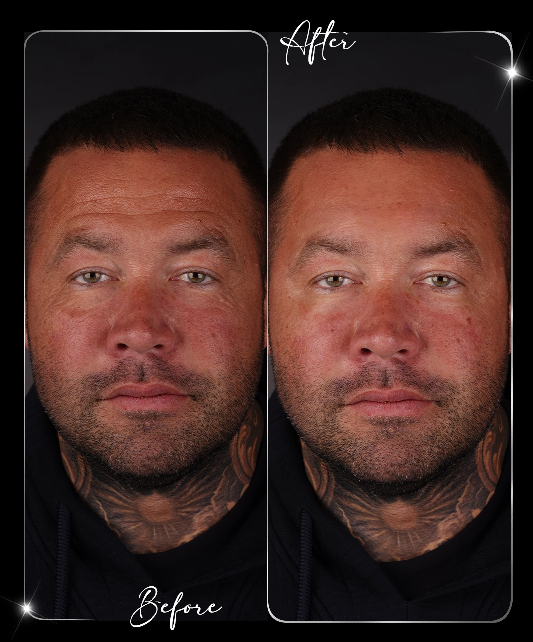 Botox – Înainte și după – 4
