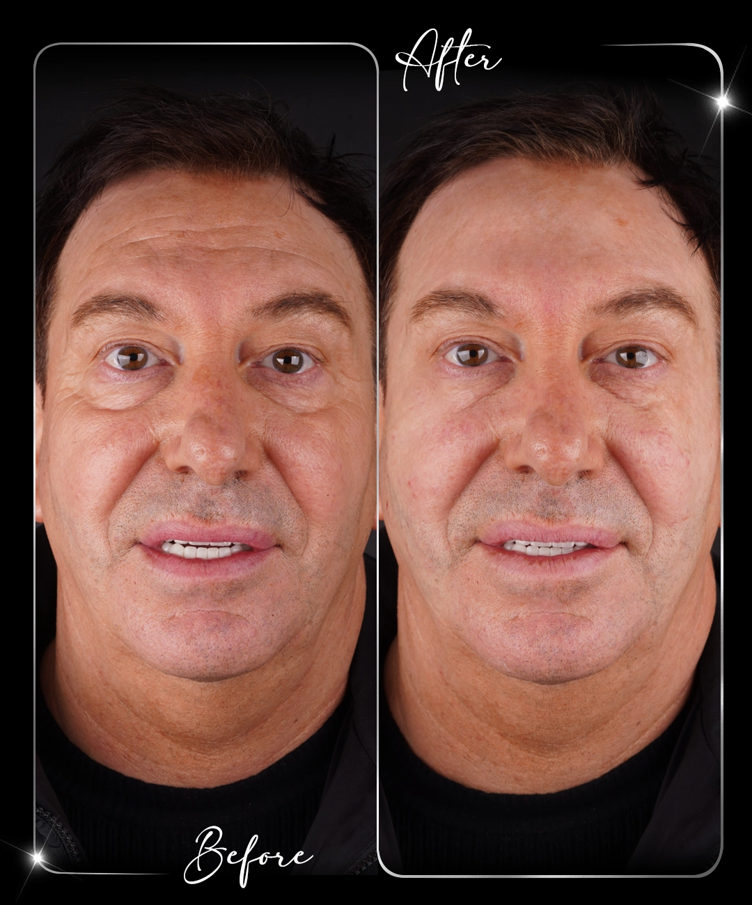 Botox – Înainte și după – 5