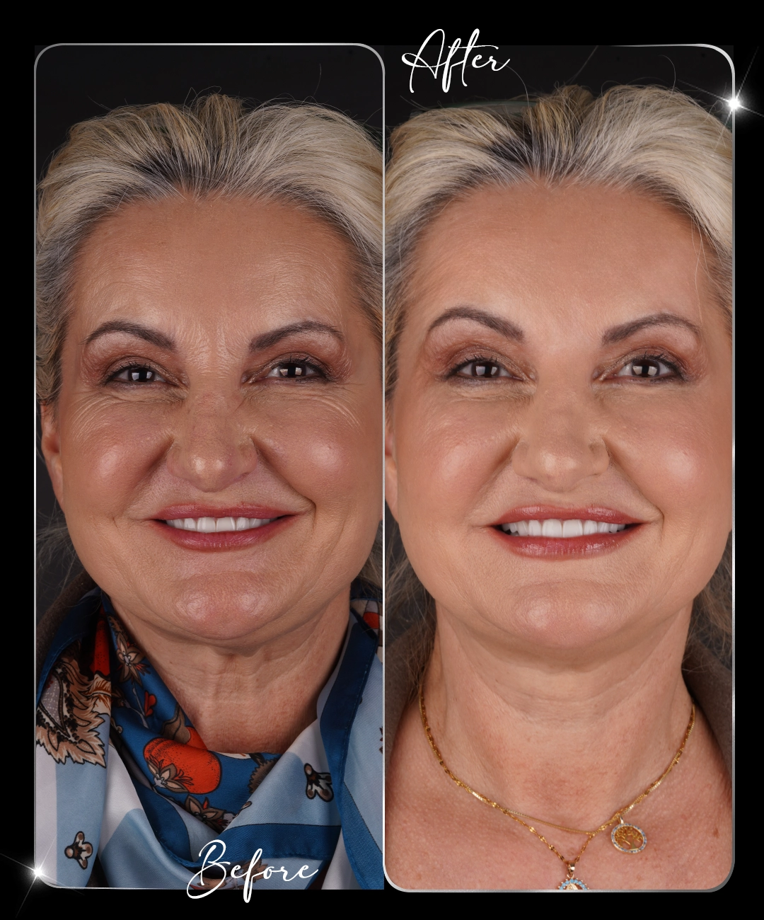 Botox – Înainte și după – 6