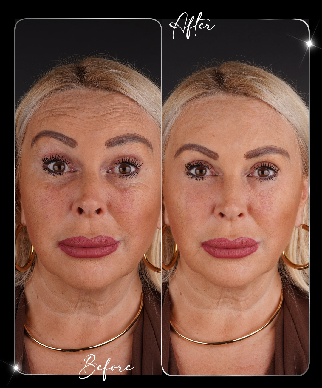 Botox-după-8