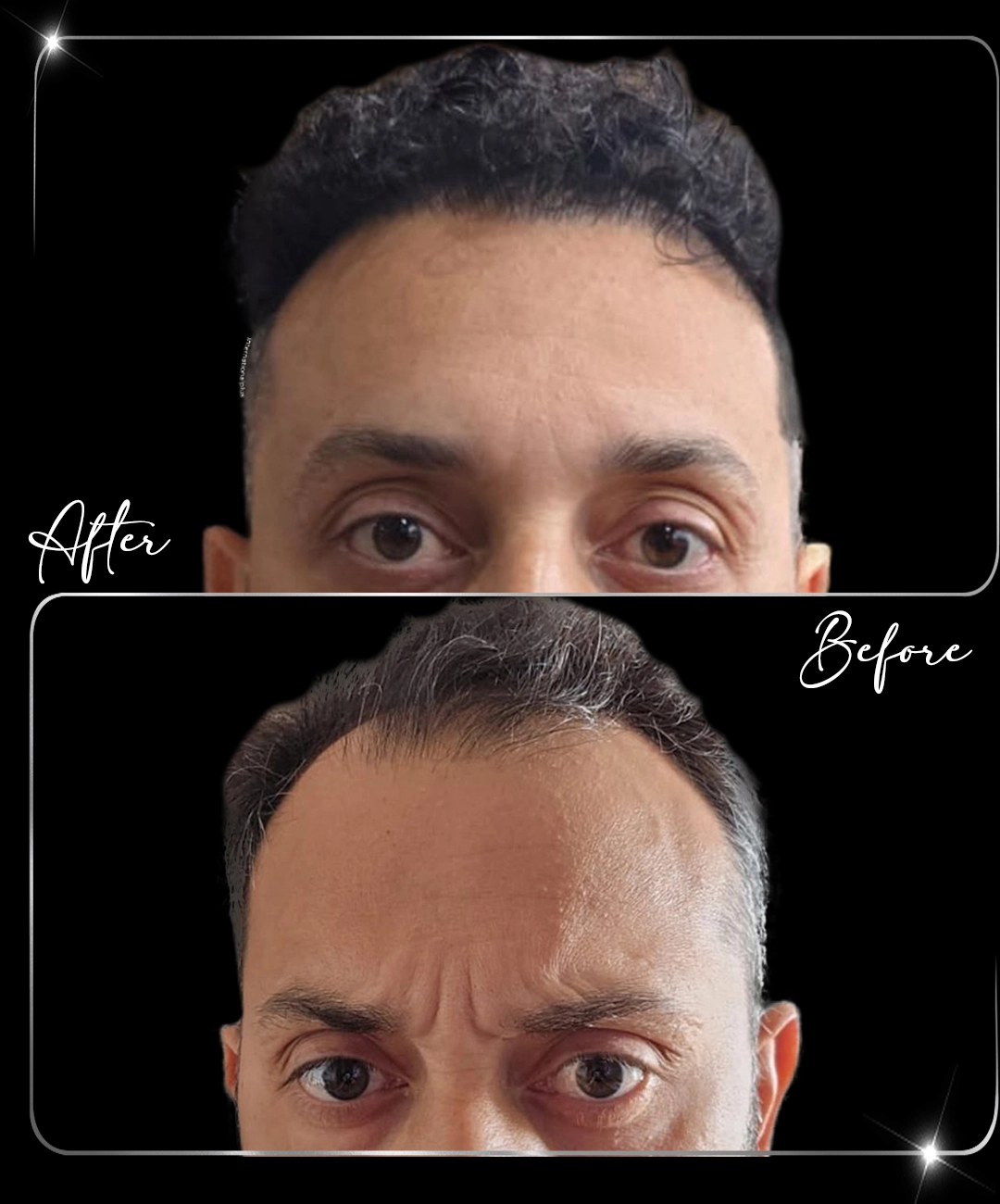 Transplant de păr – înainte și după – 3