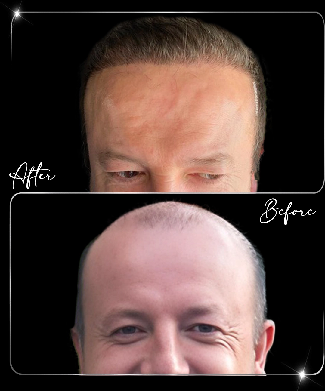 Transplant de păr – înainte și după – 5