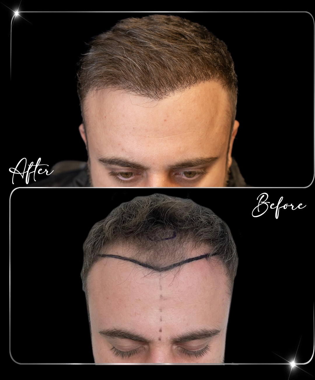 Transplant de păr – Înainte și după – 8