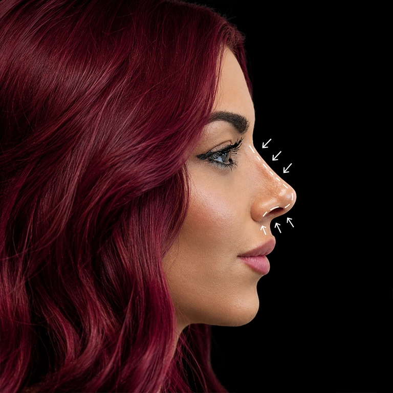 Rhinoplasty