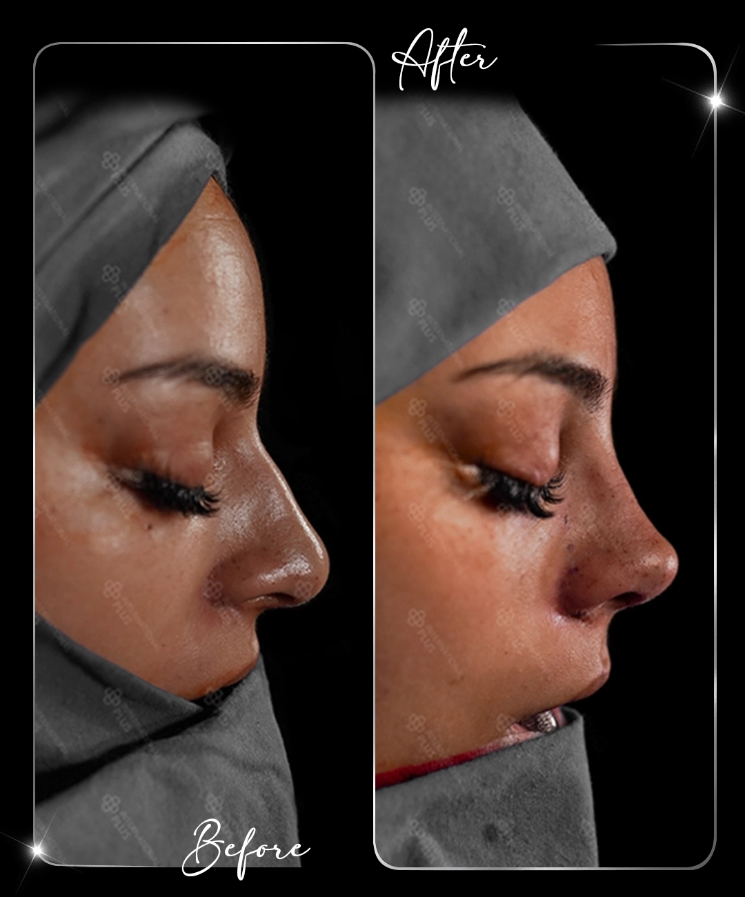 Rinoplastie – Înainte și după – 1