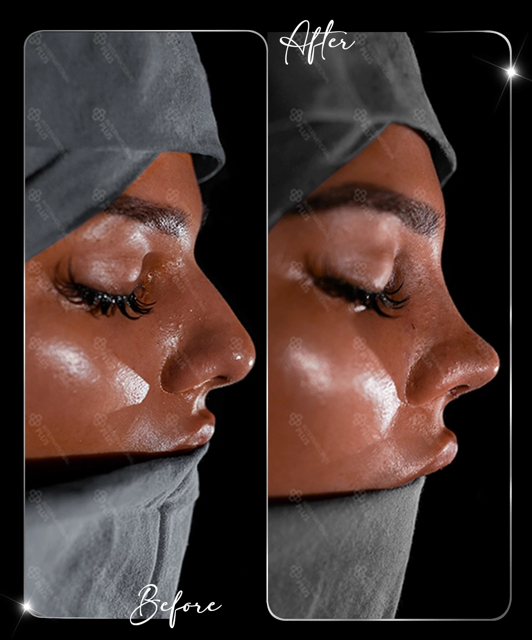 Rinoplastie – Înainte și după – 2