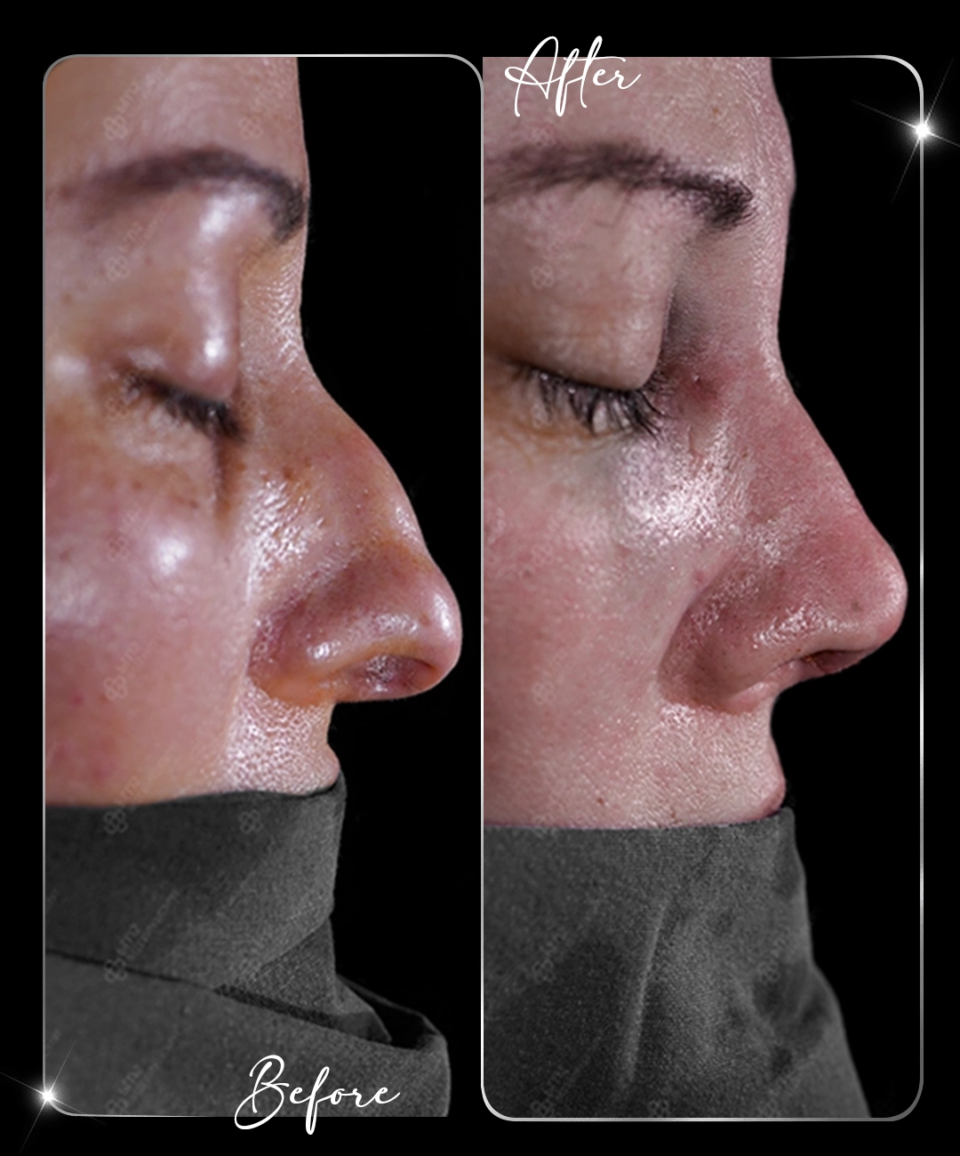 Rinoplastie – Înainte și după – 3