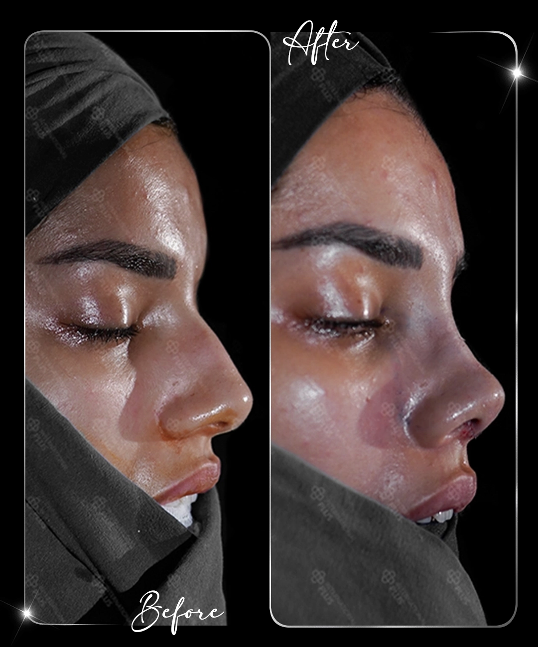 Rinoplastie – Înainte și după – 4