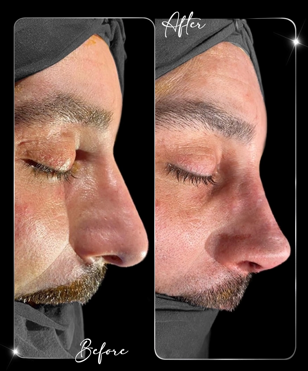 Rinoplastie – Înainte și după – 7