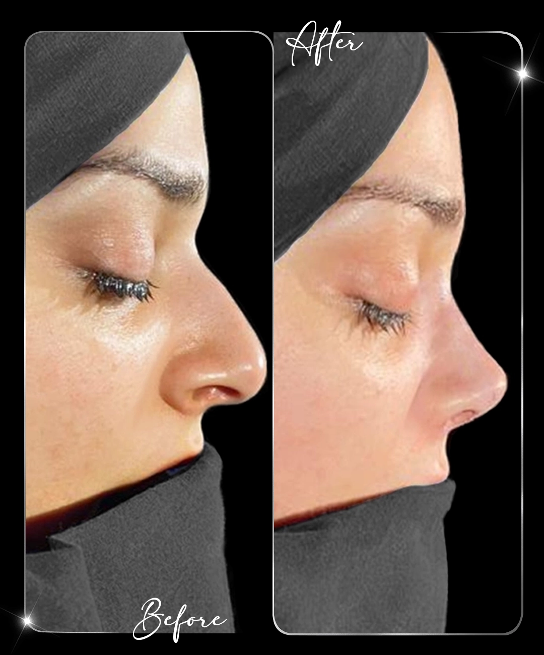 Rinoplastie – Înainte și după – 9