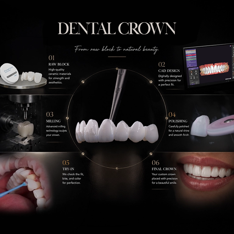 De ce să ne alegeți pentru coroane dentare în Istanbul, Turcia?