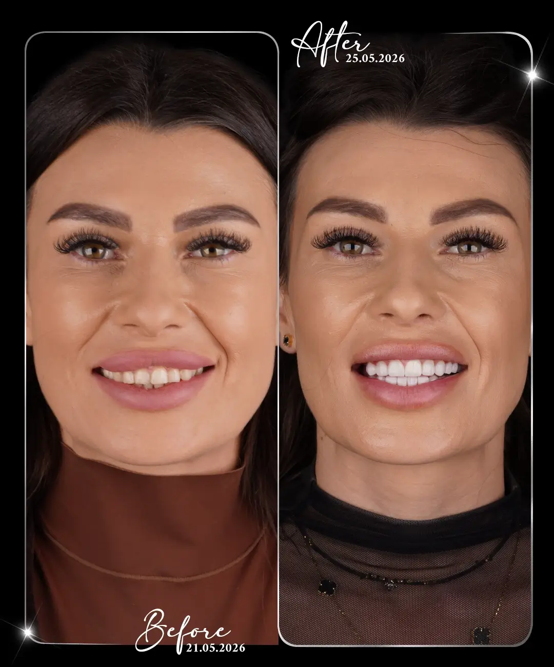 Coroană dentară – înainte și după – 2