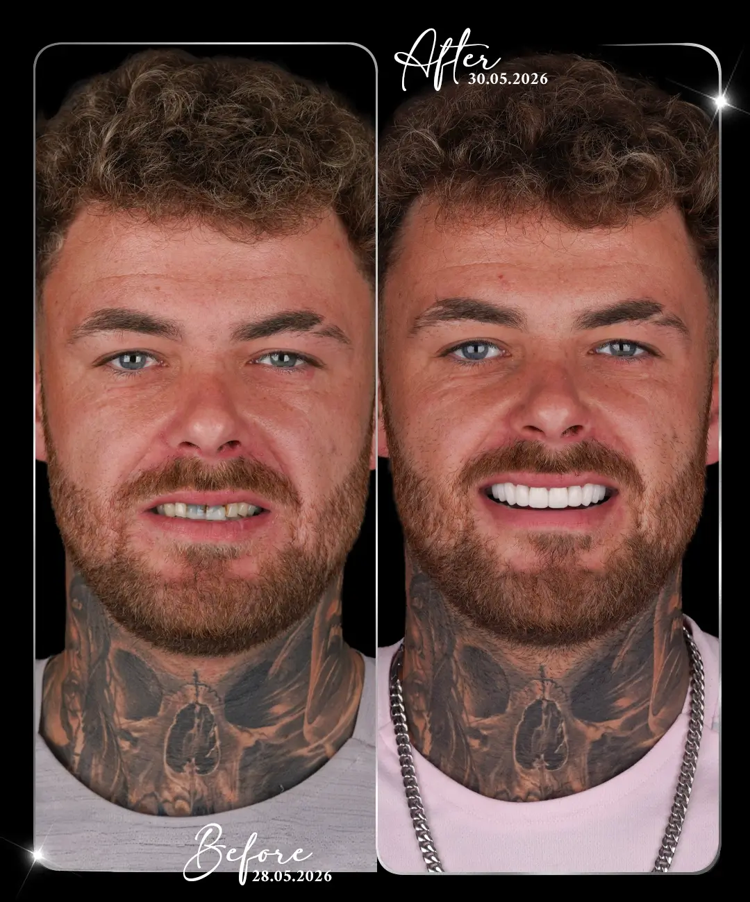 Coroană dentară – înainte și după – 3