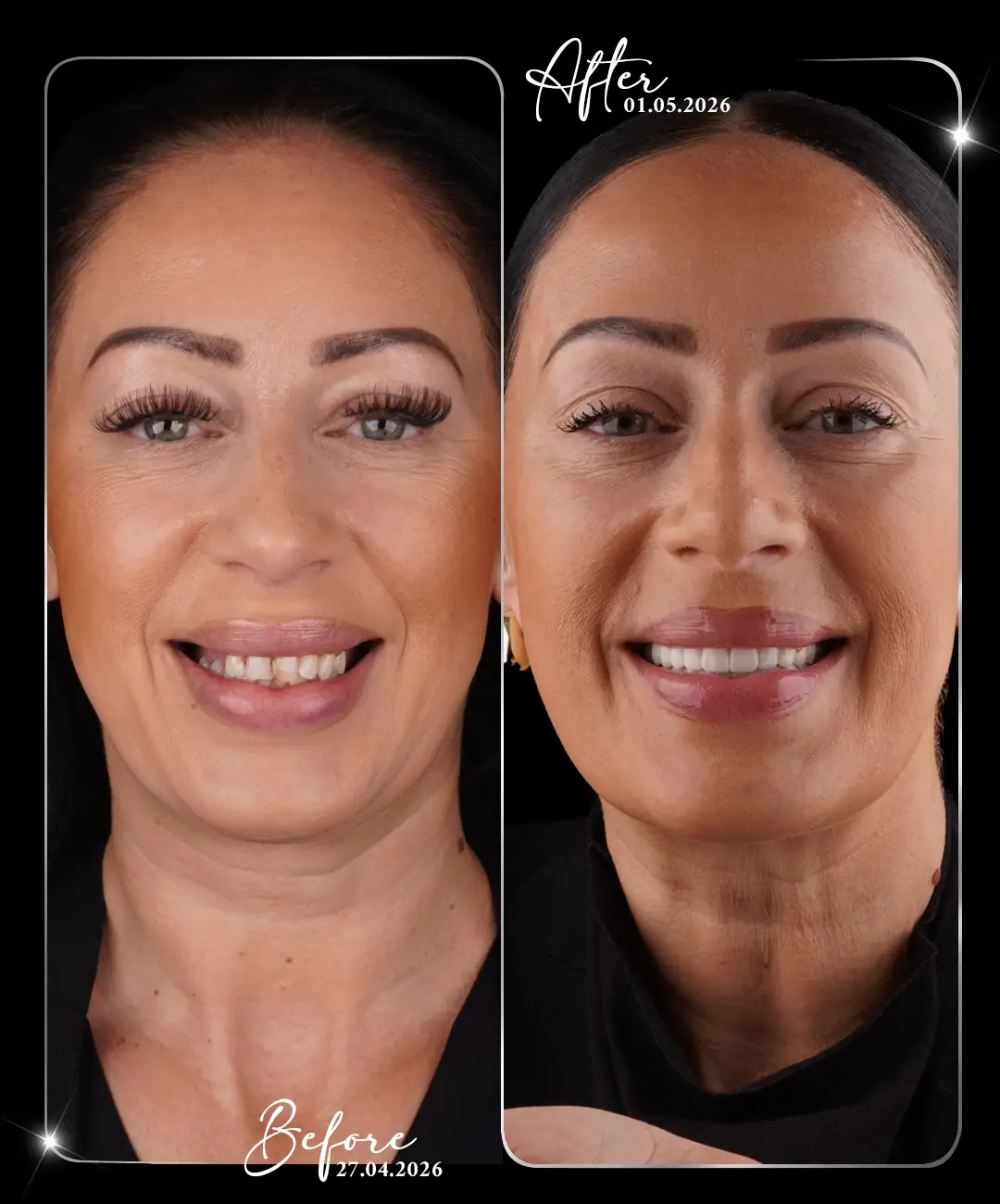 Coroană dentară – înainte și după – 5