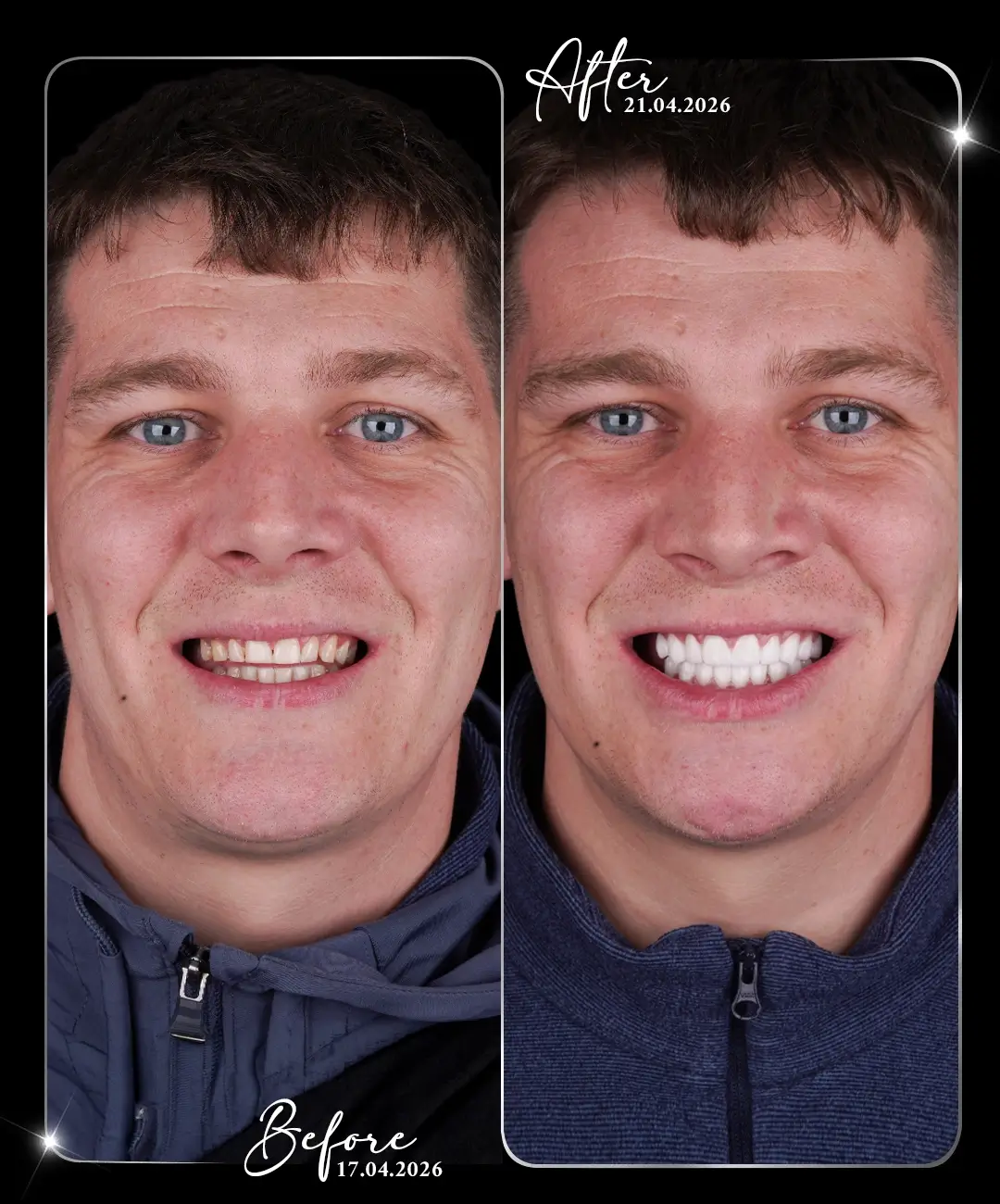 Coroană dentară – înainte și după – 9