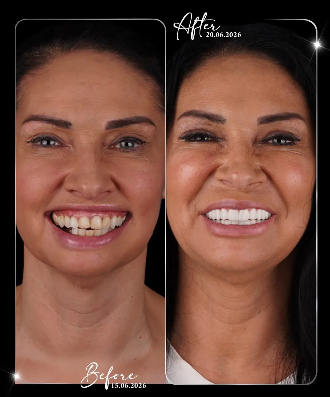Implant dentar – înainte și după – 1