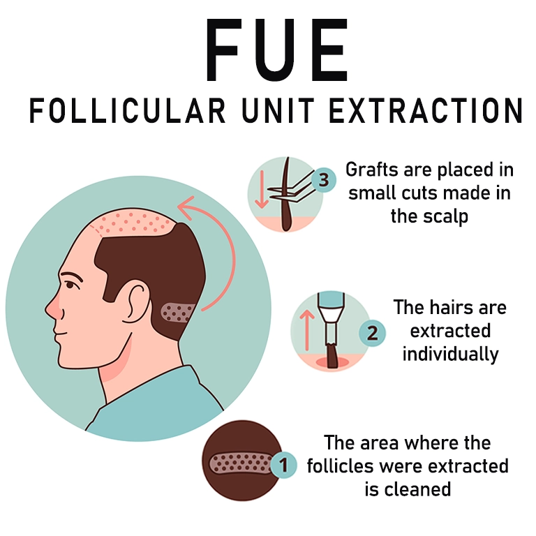 Tehnica FUE (extragerea unităților foliculare)