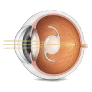 Lentilă intraoculară monofocală