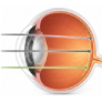 Lentilă intraoculară trifocală