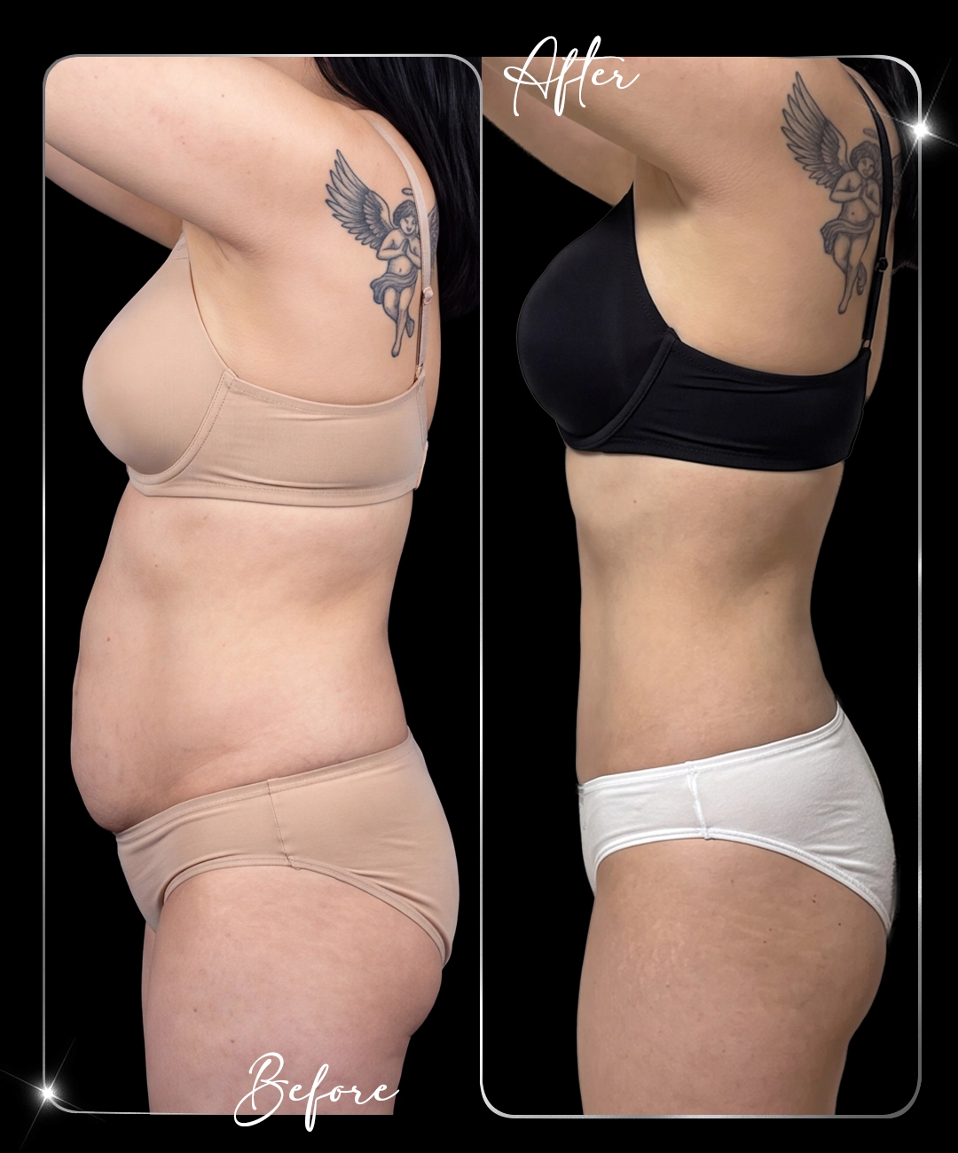 Abdominoplastie – Înainte și după – 4