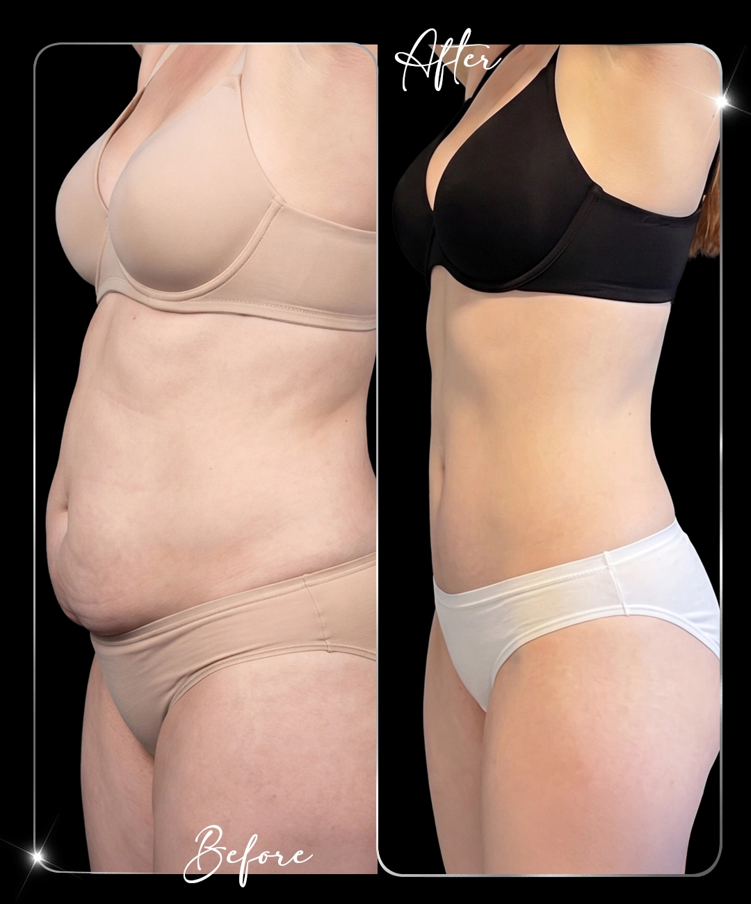 Abdominoplastie – Înainte și după – 5