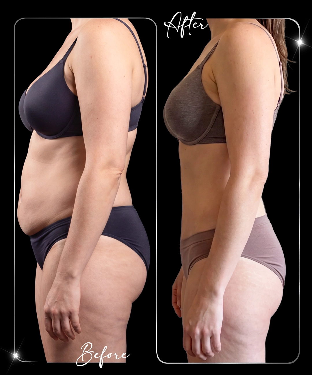 Abdominoplastie – Înainte și după – 7