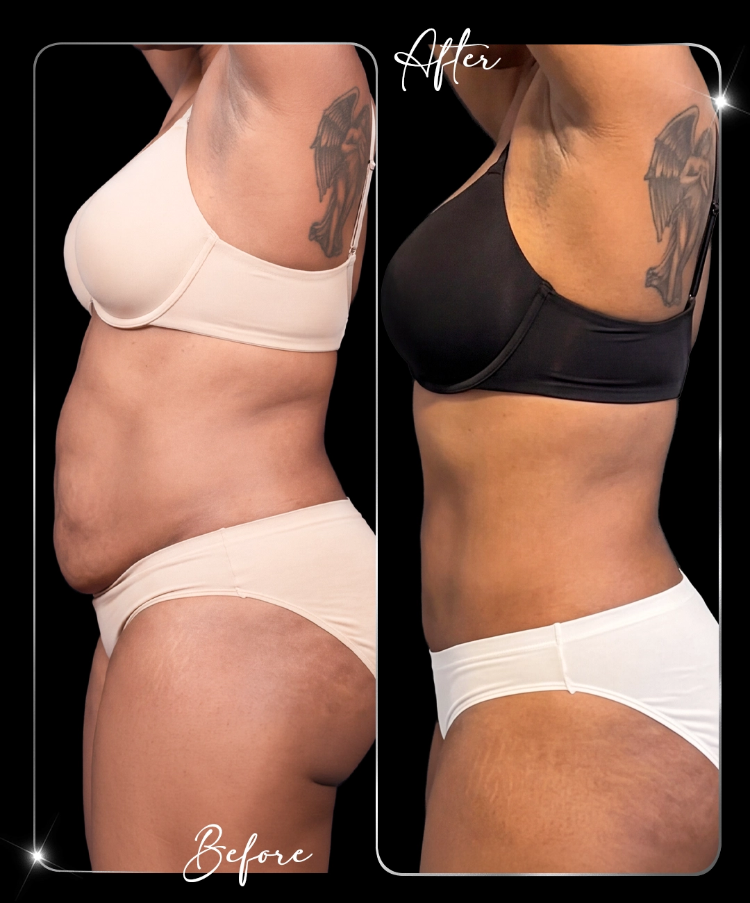 Abdominoplastie – Înainte și după – 9